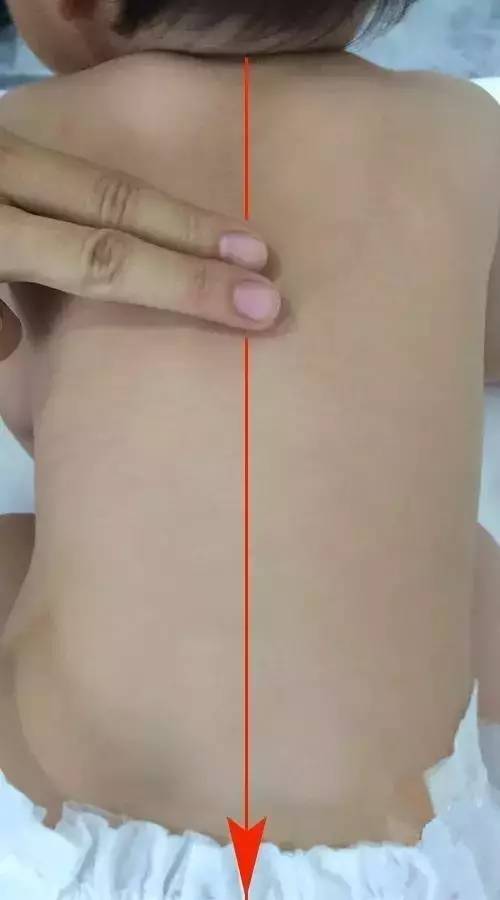 捏脊